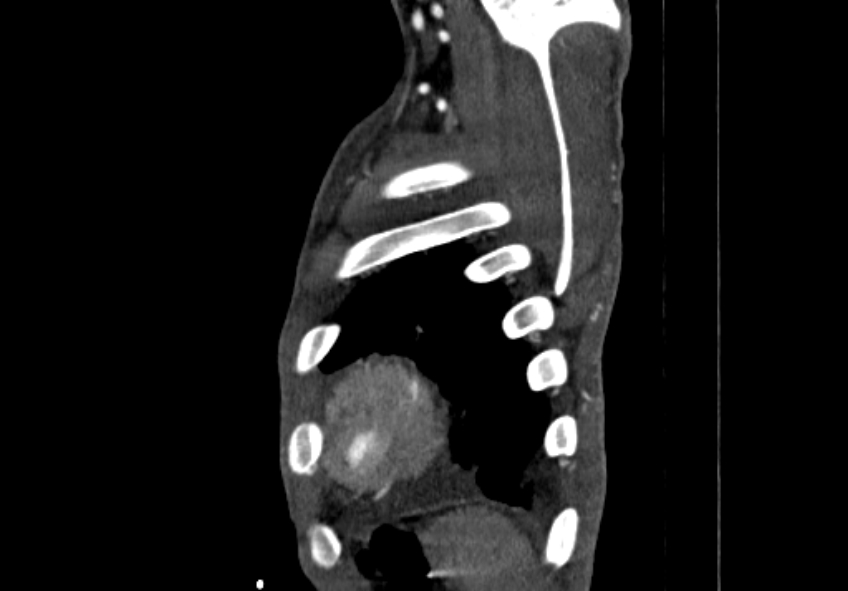 Coarctation of aorta with aortic valve stenosis (Radiopaedia 70463-80574 B 228).jpg