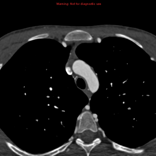 File:Coarctation of the aorta (Radiopaedia 12461-12697 A 44).jpg