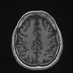 File:Cochlear incomplete partition type III associated with hypothalamic hamartoma (Radiopaedia 88756-105498 Axial T1 141).jpg