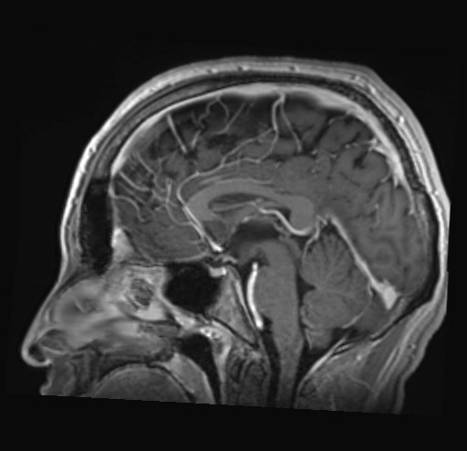 Cochlear incomplete partition type III associated with hypothalamic hamartoma (Radiopaedia 88756-105498 Sagittal T1 C+ 27).jpg