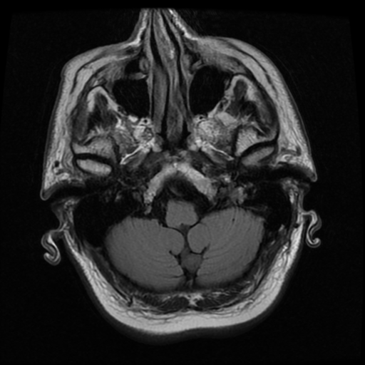 File:Colloid cyst (large) (Radiopaedia 34415-35729 Axial FLAIR 4).png