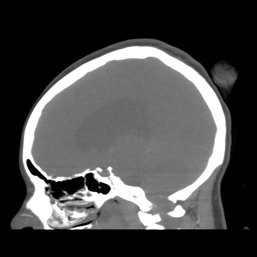 File:Colloid cyst (resulting in death) (Radiopaedia 33423-34499 B 32).png