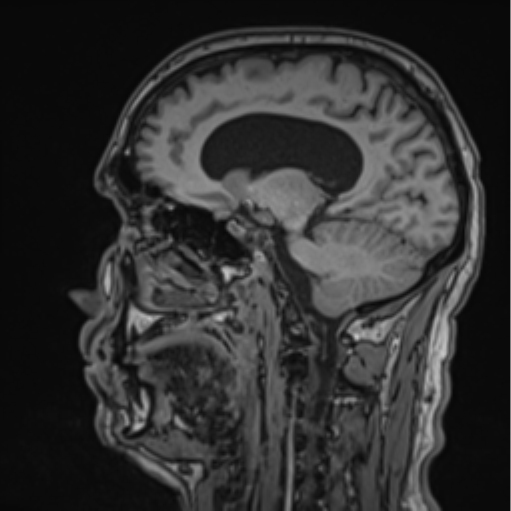 File:Colloid cyst of the third ventricle (Radiopaedia 86571-102662 Sagittal T1 33).png
