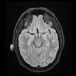 File:Colloid cyst with anterior communicating artery aneurysm (Radiopaedia 33901-35091 Axial FLAIR 10).jpg