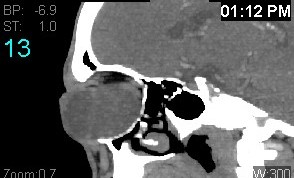 File:Colobomatous cyst (Radiopaedia 18034-17803 B 13).jpg