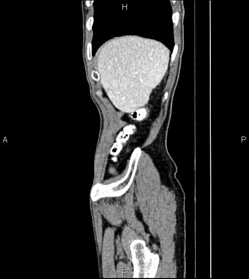 Colon adenocarcinoma - hepatic flexure (Radiopaedia 85635-101395 D 9).jpg