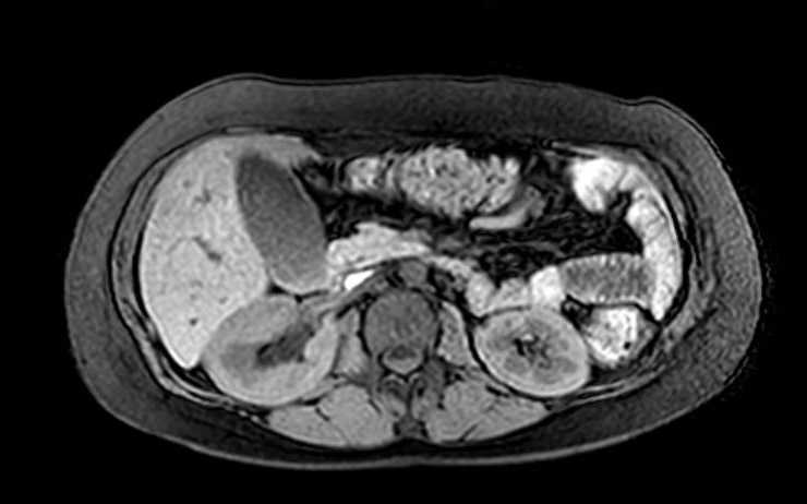 File:Colon adenocarcinoma with Krukenberg tumors, advanced pregnancy (Radiopaedia 67279-76645 A 53).jpg