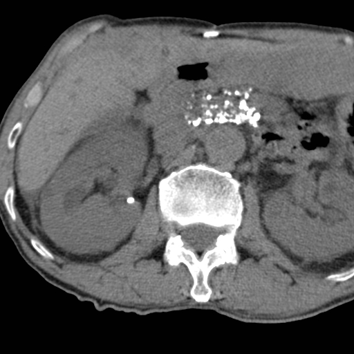 Colon cancer with calcified liver metastasis (Radiopaedia 74423-85309 Axial non-contrast 36).jpg