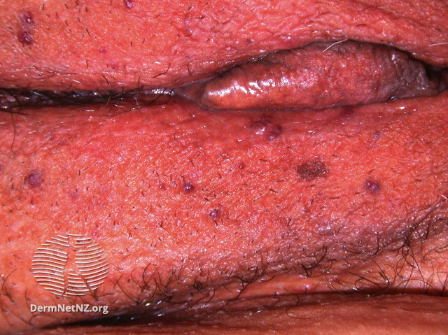 File:Dermoscopy of angiokeratoma of Fordyce on vulva (DermNet NZ angiokeratoma-20).jpg