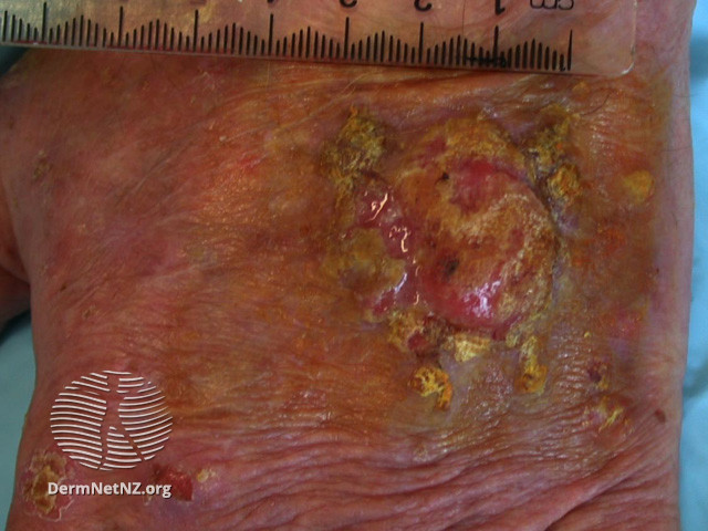 File:Intraepidermal carcinoma (DermNet NZ lesions-scc-in-situ-2962).jpg