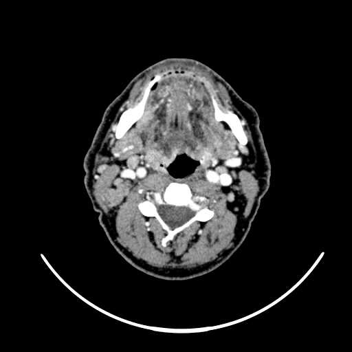 File:Nasopharyngeal carcinoma - infiltrating the clivus (Radiopaedia 62583-70875 Axial Post contrast 36).jpg