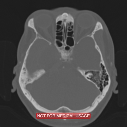 Nasopharyngeal carcinoma recurrence - skull base destruction (Radiopaedia 29107-29490 Axial bone window 76).jpg