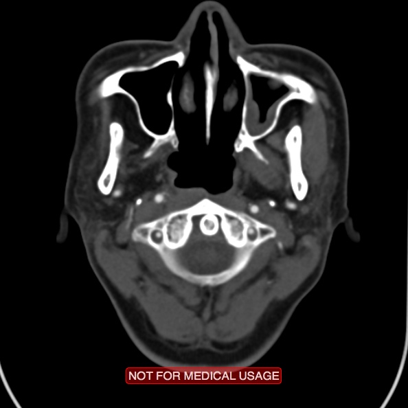 File:Nasopharyngeal carcinoma recurrence - skull base destruction (Radiopaedia 29107-29491 A 12).jpg