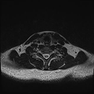 Nasopharyngeal carcinoma with perineural spread (Radiopaedia 55030-61380 Axial T2 72).jpg