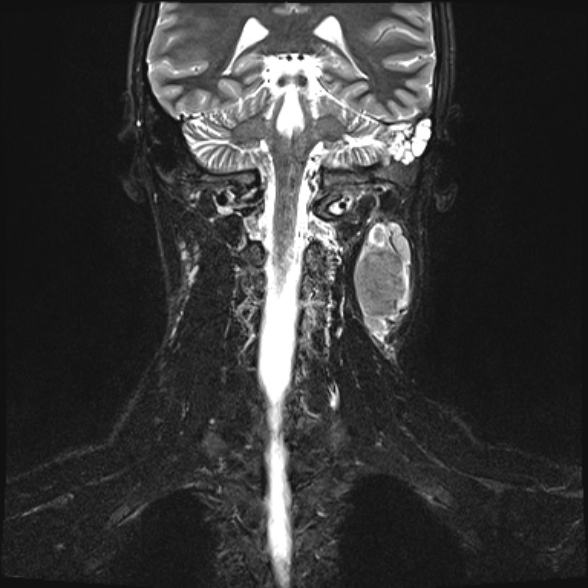 Nasopharyngeal carcinoma with skull base invasion (Radiopaedia 53415-59485 Coronal T2 fat sat 7).jpg