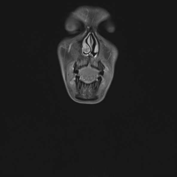 Nasopharyngeal carcinoma with skull base invasion (Radiopaedia 53415-59485 E 41).jpg