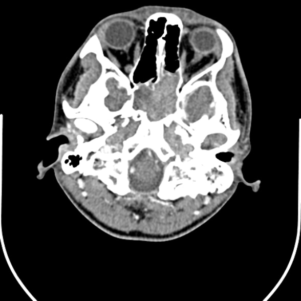Nasopharyngeal carcinoma with skull base invasion (Radiopaedia 53415-59705 A 23).jpg