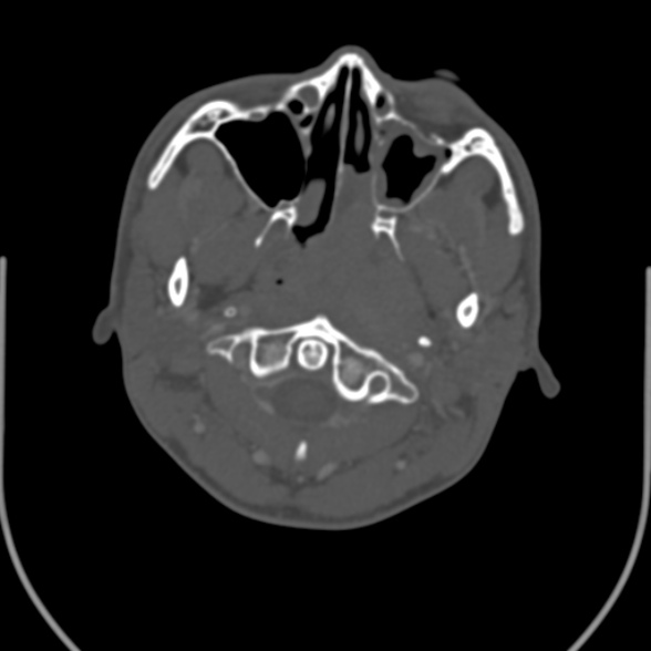Nasopharyngeal carcinoma with skull base invasion (Radiopaedia 53415-59705 Axial bone window 48).jpg