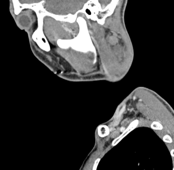 Nasopharyngeal carcinoma with skull base invasion (Radiopaedia 53415-59705 C 61).jpg