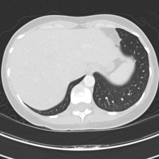 File:Necrobiotic pulmonary nodules - Crohn disease (Radiopaedia 20723-20631 Axial lung window 124).jpg