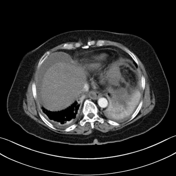 File:Necrotizing emphysematous pancreatitis (Radiopaedia 25727-25893 A 24).jpg