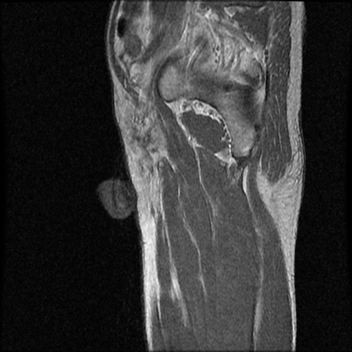 File:Necrotizing epididymo-orchitis with intra-testicular abscess (Radiopaedia 29397-29860 Sagittal T1 C+ 2).jpg