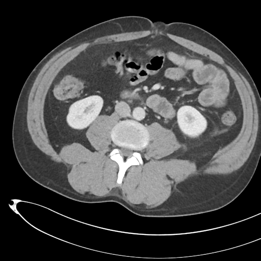 File:Necrotizing pancreatitis with acute necrotic collections (Radiopaedia 38829-41012 B 45).png