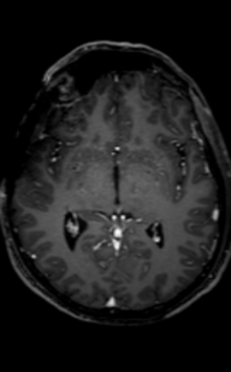 Neuro-Behçet disease (Radiopaedia 90112-107294 Axial T1 C+ 134).jpg