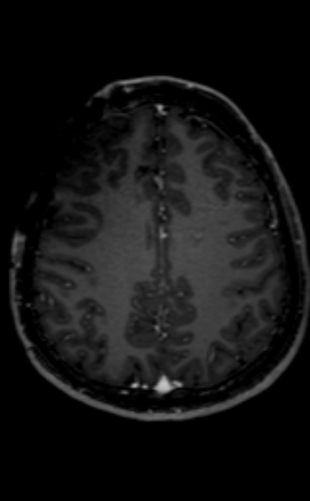 Neuro-Behçet disease (Radiopaedia 90112-107294 Axial T1 C+ 92).jpg