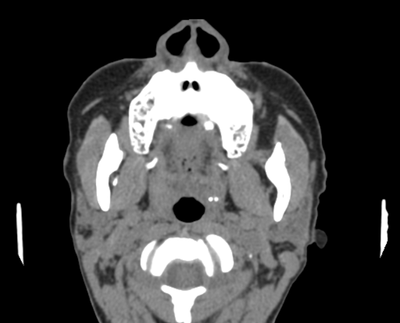 Neurofibromatosis type 1- orbital manifestations (Radiopaedia 49391-54511 Axial non-contrast 11).jpg
