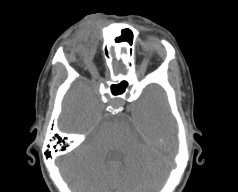 Neurofibromatosis type 1- orbital manifestations (Radiopaedia 49391-54511 Axial non-contrast 55).jpg