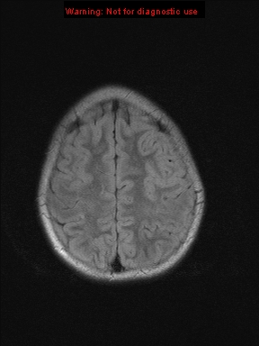File:Neurofibromatosis type 1 with optic nerve glioma (Radiopaedia 16288-15965 Axial FLAIR 5).jpg