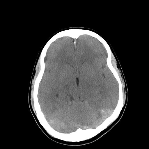 File:Neurofibromatosis type 2 (Radiopaedia 25389-25637 Axial non-contrast 11).jpg