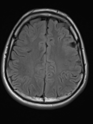 File:Neurofibromatosis type 2 (Radiopaedia 44936-48838 Axial FLAIR 17).png