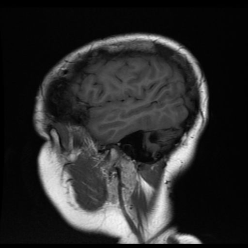 File:Neurofibromatosis type 2 (Radiopaedia 45229-49251 Sagittal T1 3).png
