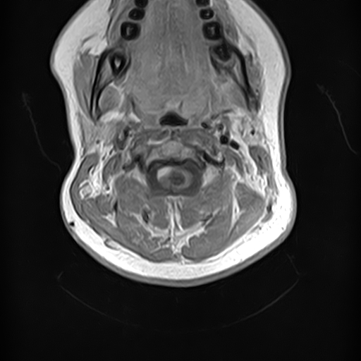 File:Neurofibromatosis type 2 (Radiopaedia 66211-75403 Axial T1 C+ 6).jpg