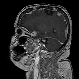 File:Neurofibromatosis type 2 (Radiopaedia 8713-9518 Sagittal T1 C+ 17).jpg