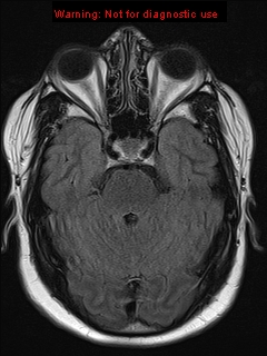 File:Neuroglial cyst (Radiopaedia 10713-11184 Axial FLAIR 16).jpg