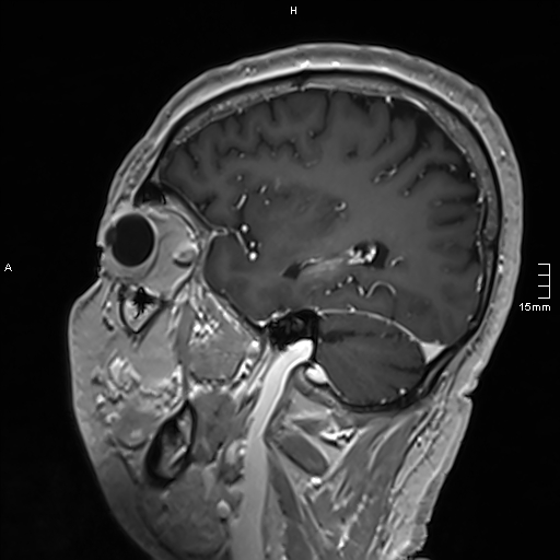 Neurosarcoidosis - involvement of the mesial temporal lobes (Radiopaedia 67429-76820 Sagittal T1 C+ 121).jpg