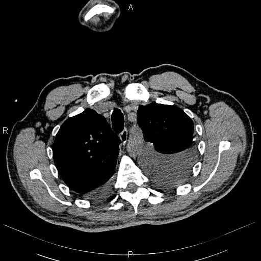 File:Non Hodgkin lymphoma in a patient with ankylosing spondylitis (Radiopaedia 84323-99621 Axial non-contrast 7).jpg