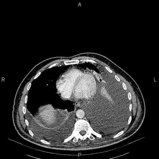 File:Non Hodgkin lymphoma in a patient with ankylosing spondylitis (Radiopaedia 84323-99621 B 24).jpg