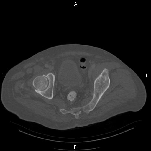 Non Hodgkin lymphoma in a patient with ankylosing spondylitis (Radiopaedia 84323-99624 Axial bone window 59).jpg