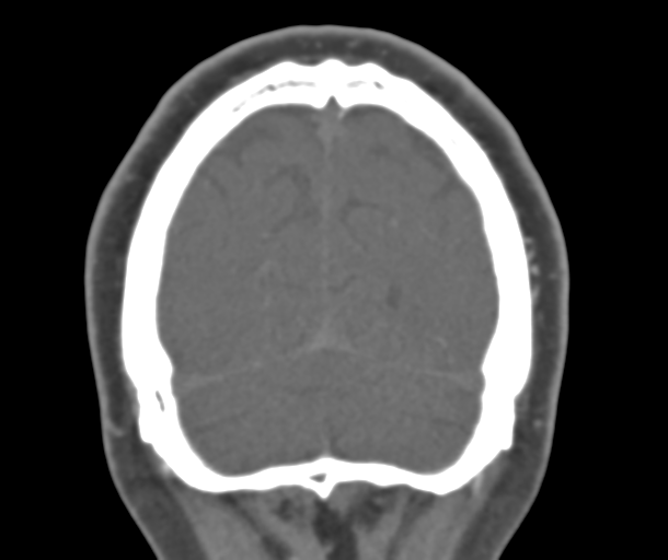 File:Normal CTA head (Radiopaedia 40801-43464 B 82).png