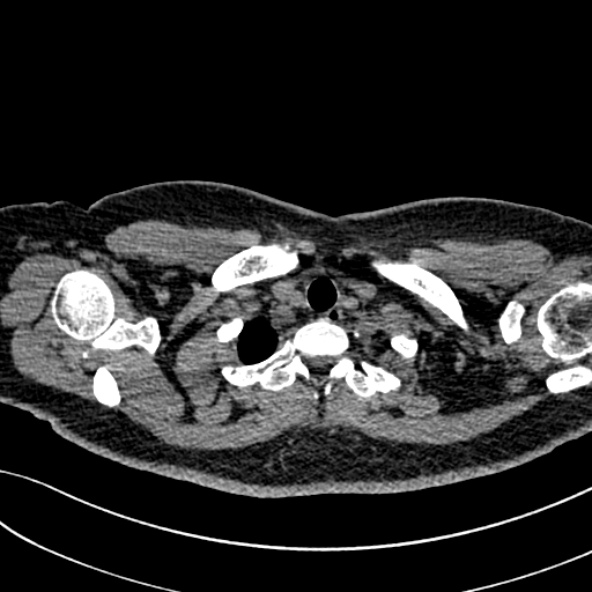Normal CT chest- adult female (Radiopaedia 52522-58428 Axial non-contrast 13).jpg