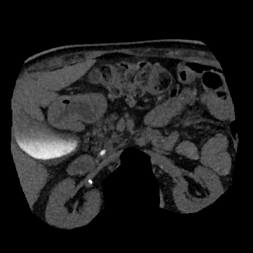 File:Normal CT intravenous cholangiogram (Radiopaedia 38199-40208 Axial IVC (MIP) 27).png