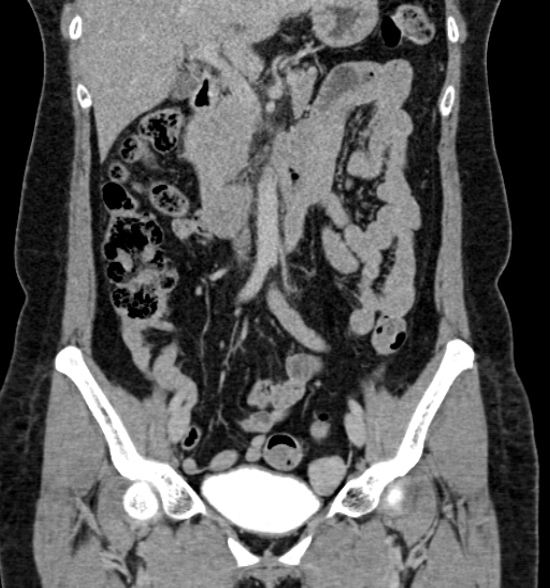 Normal CT intravenous urogram (Radiopaedia 39444-41759 A 246).jpg