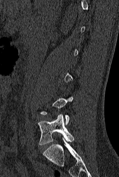 File:Normal CT lumbar spine (Radiopaedia 53981-60118 Sagittal bone window 26).jpg