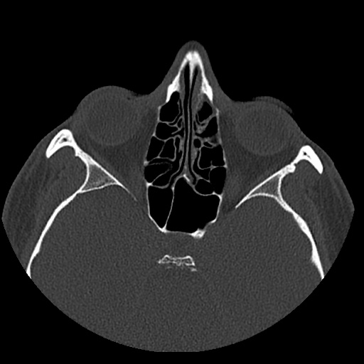 Normal CT paranasal sinuses (Radiopaedia 42286-45390 Axial bone window 50).jpg