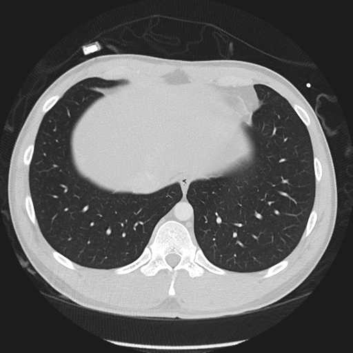 Normal CT pulmonary veins (pre RF ablation) (Radiopaedia 41748-44702 Axial lung window 54).png