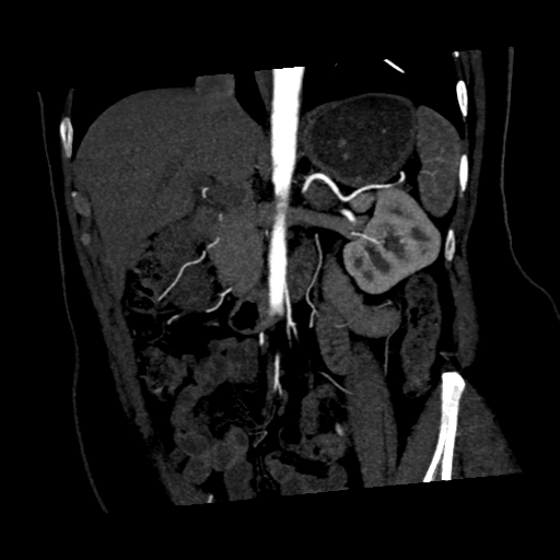 File:Normal CT renal artery angiogram (Radiopaedia 38727-40889 C 9).png